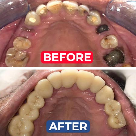 dental crowns treatment in Vijayawada