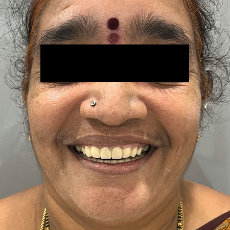 female patient after full mouth rehabilitation