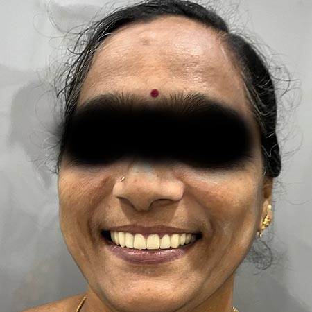 female patient after tooth decay treatment