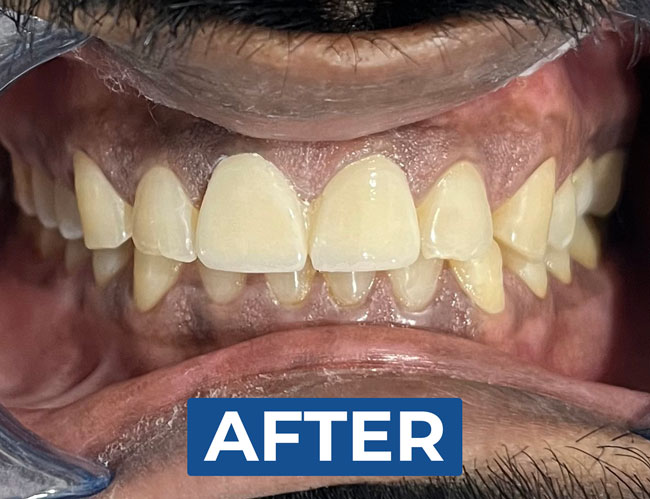 after zirconia crowns