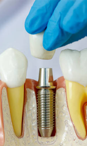 Dental Implants in Vijayawada