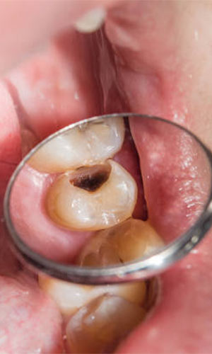 Fillings/cavities Treatment in Vijayawada