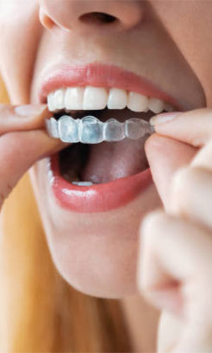 Aligners Treatment in Vijayawada