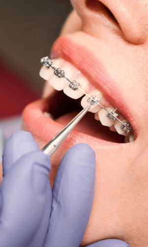 dental braces and retainers