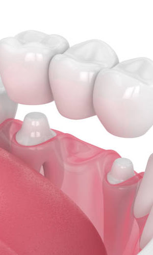 dental crowns and tooth bridges