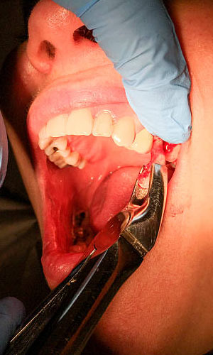 dental extraction